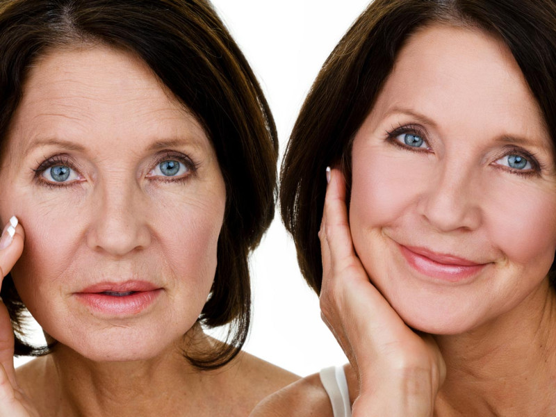 Rajeunissement Facial à Javea avec le Dr. Caroline Carbasse : Mini Liftings Sans Chirurgie