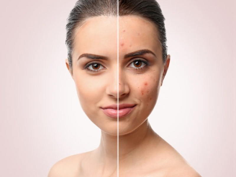 Traitement de l'Acné avec IPL à Estetica Javea : Retrouver une Peau Saine et Rayonnante